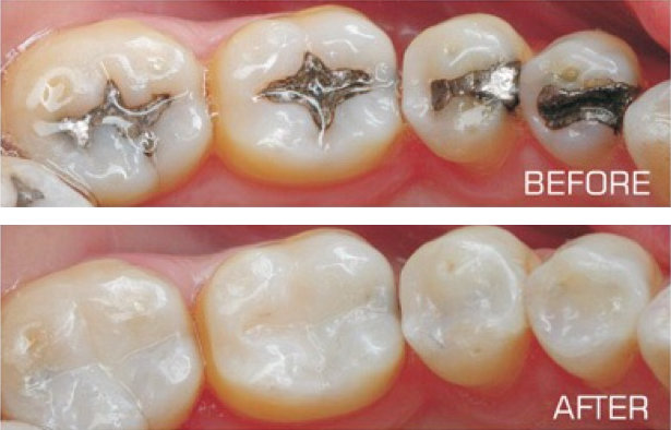Tooth Colored Restoration