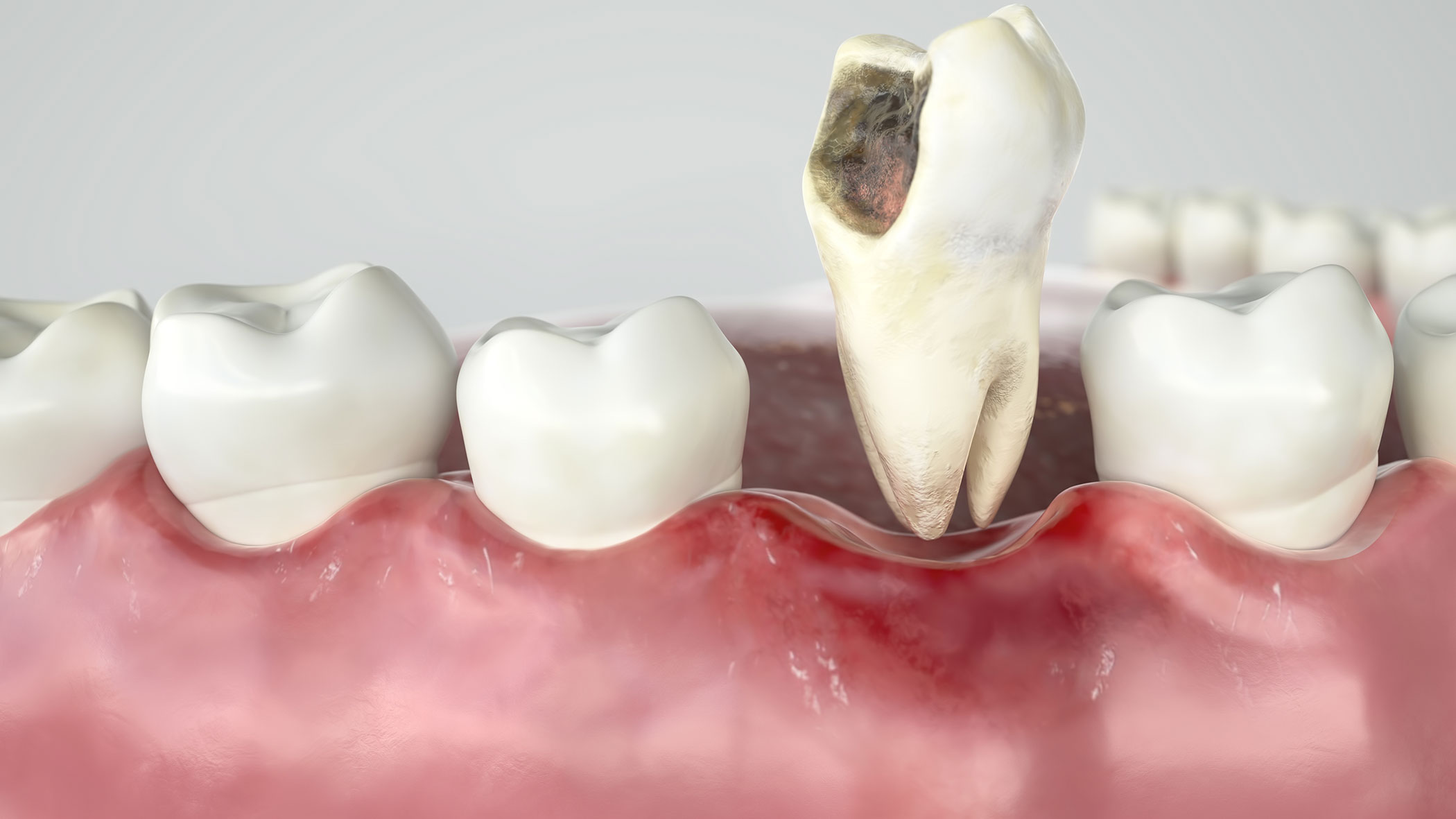 Tooth Extraction and Impaction